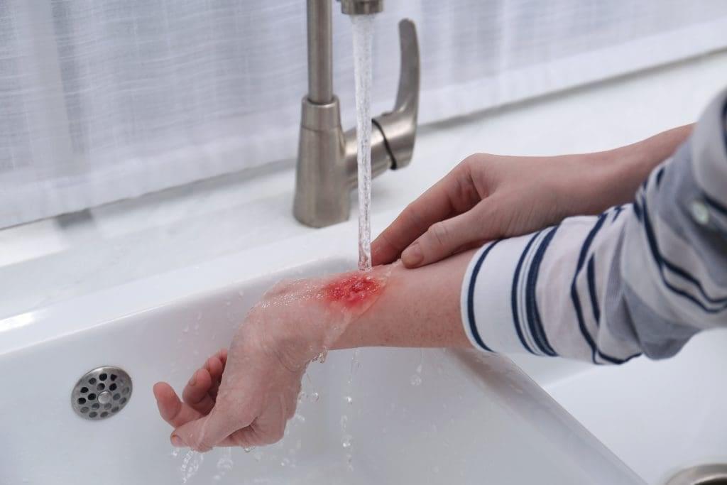 A person rinsing a fresh burn injury on their wrist under cool running water at a sink